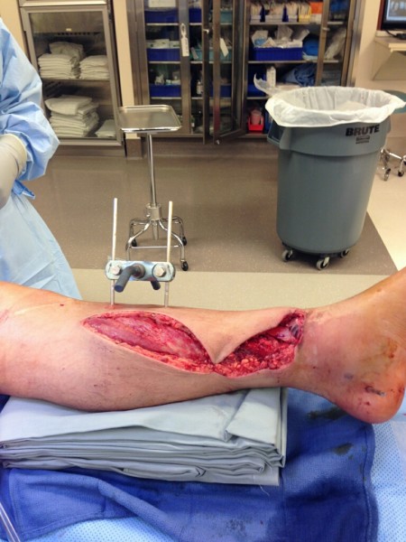 Ammon McNeely's foot after the accident. 