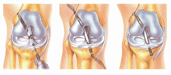 one of the ways Dr.s replace an ACL.