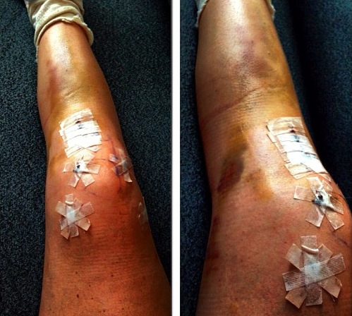 Lindsey Vonn's famous ACL surgery last year.  This is her leg post surgery.