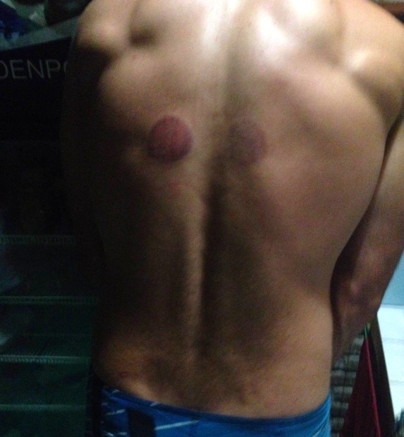 The traditional healer left these marks on my back after the cupping healing session.  I must say, I do feel better.