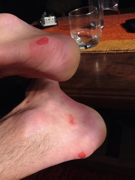 Brutalized heels after a long day in the backcountry on August 8th, 2014.
