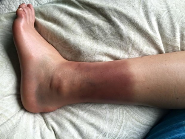 Lindsey Vonn's ankle today.