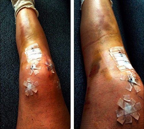 Lindsey's knee after ACL, MCL, tibial plateau surgery in 2013.