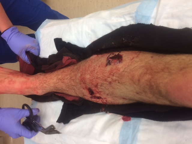 Greg's leg with 5 large puncture woulds. photo: nick bullock