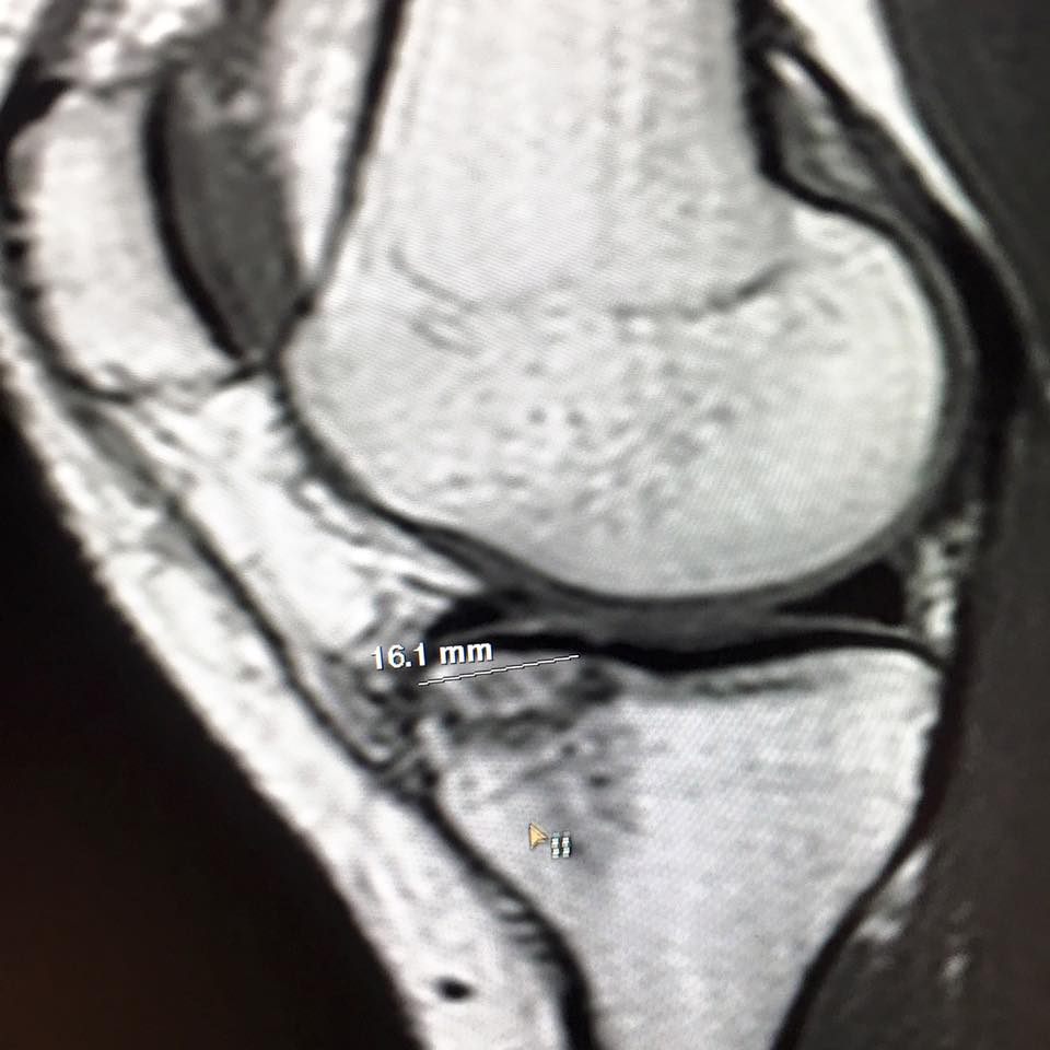 "So the MRI shows a pretty substantial fracture in my tibial plateau. MCL looks decent as well as the rest of my knee. Now I will talk to my trainers and make a plan. I'll keep you guys updated. Big thanks to everyone who helped me get through today and to the fans that always supported me!" - Lindsey Vonn, today 