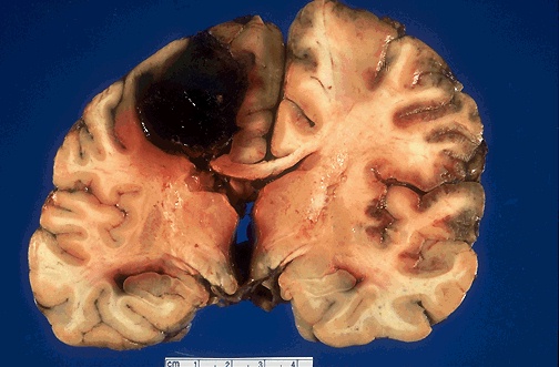 An Intracerebral Hemorrhage in a cocaine addict's brain.