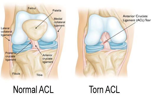 Normal-ACL