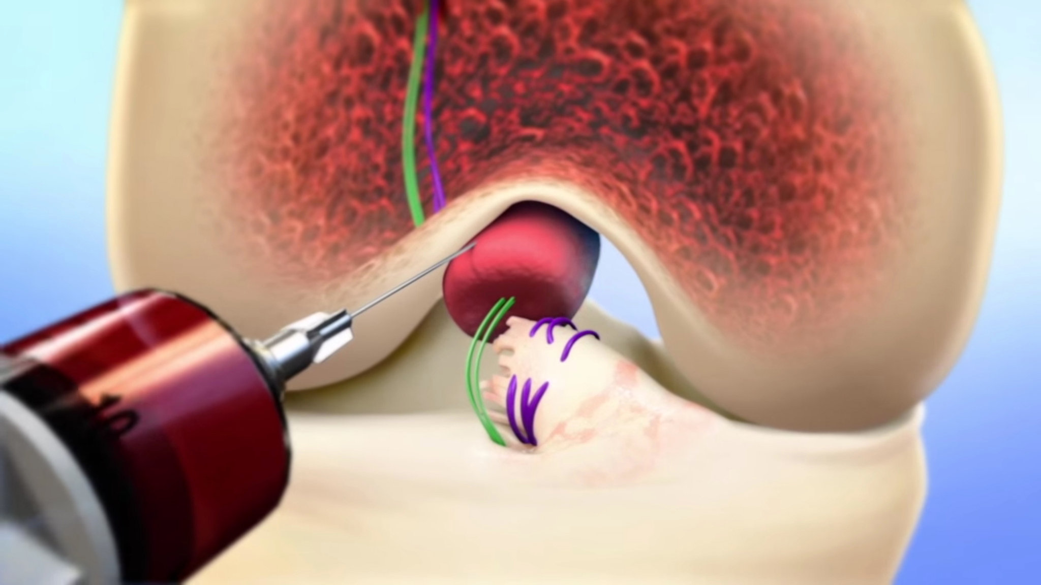 A patient's blood is injected into a sponge-like bridge that will help both ends of the torn ACL reconnect and heal in a procedure surgeons recently completed