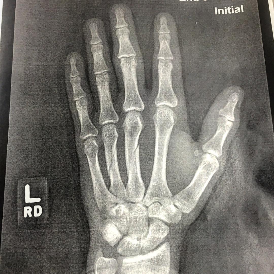 He broke his hand.