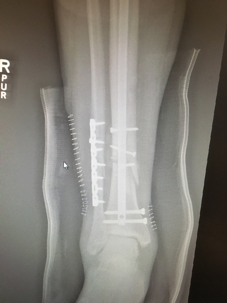 Jeremey Jones' leg injury. image: gofundme.com