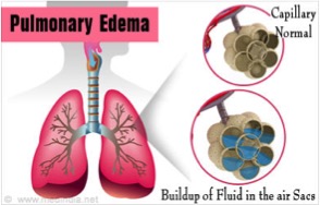 Pulmonary Edema Illustration