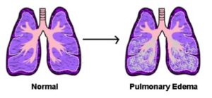 Lungs affected by Pulmonary Edema