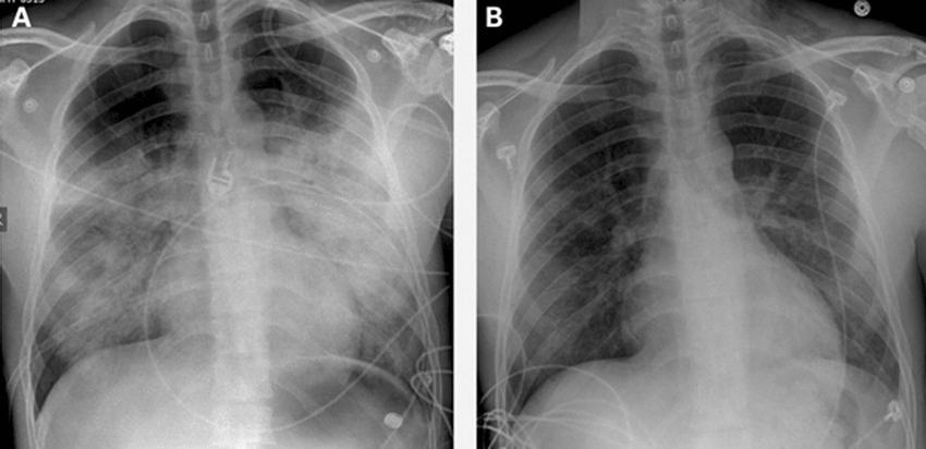Image of High Altitude Pulmonary Edema at different stages of being treated