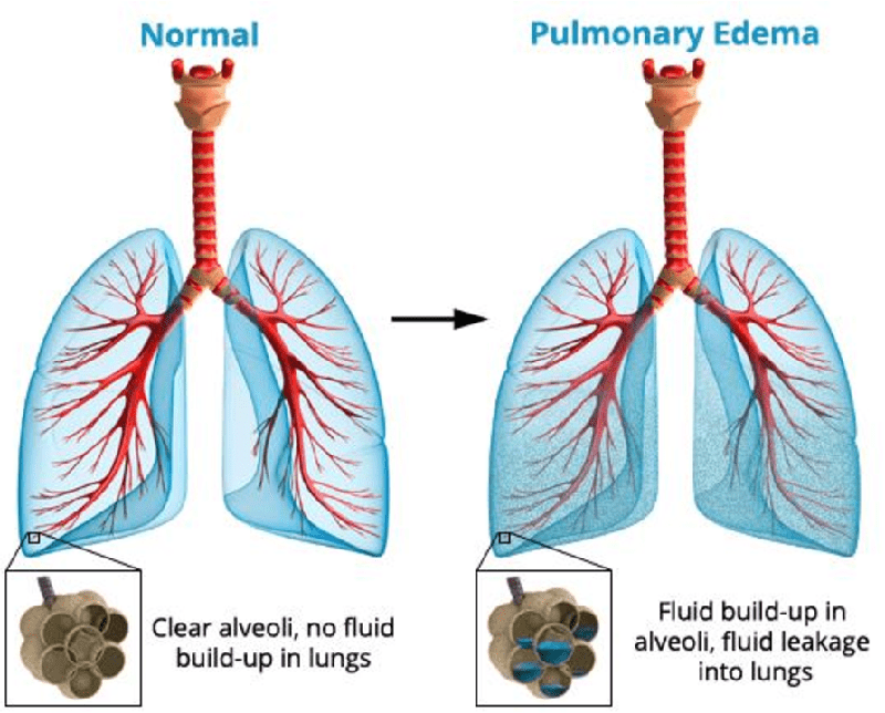 diagram, pulmonary edema