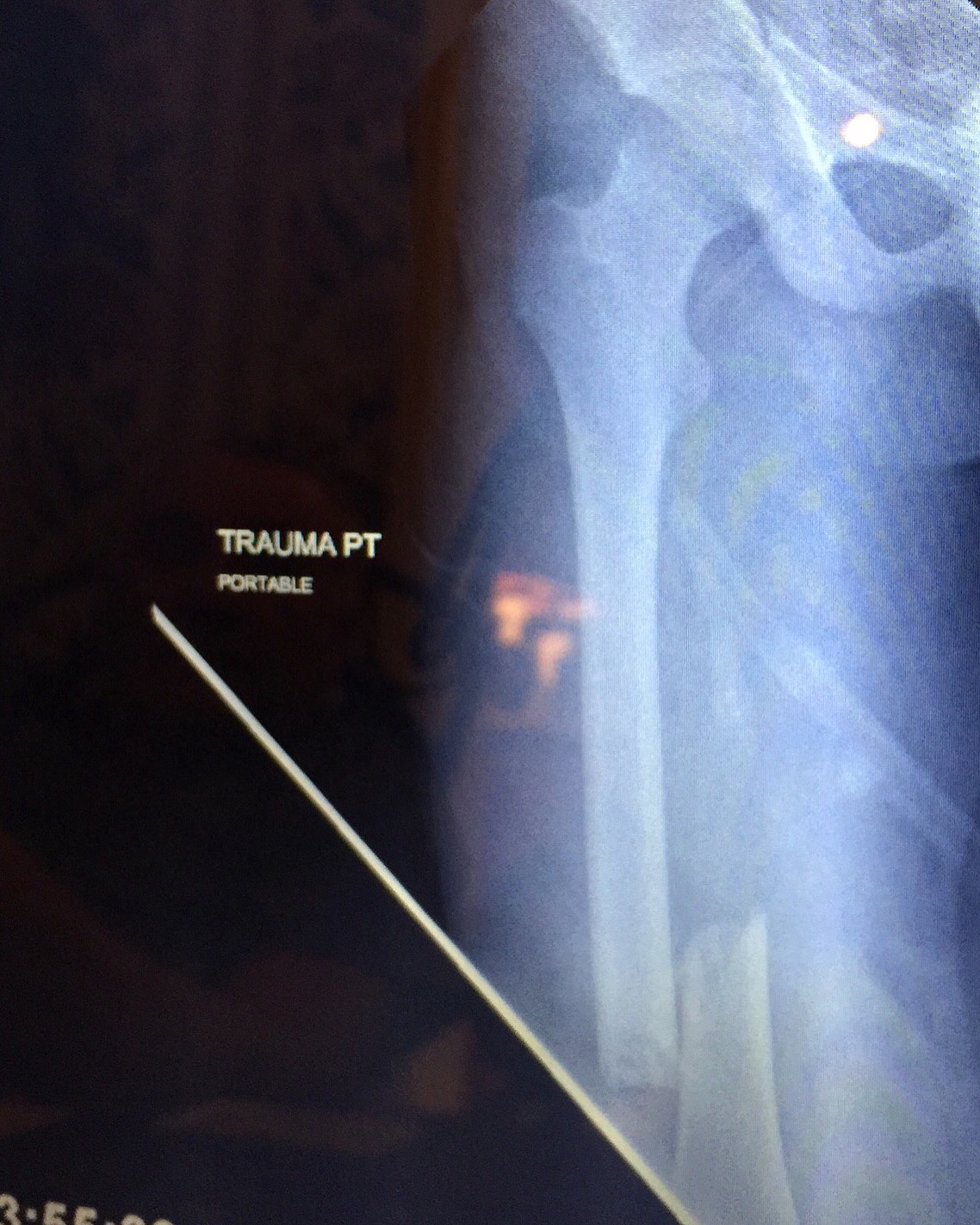 My right femur 