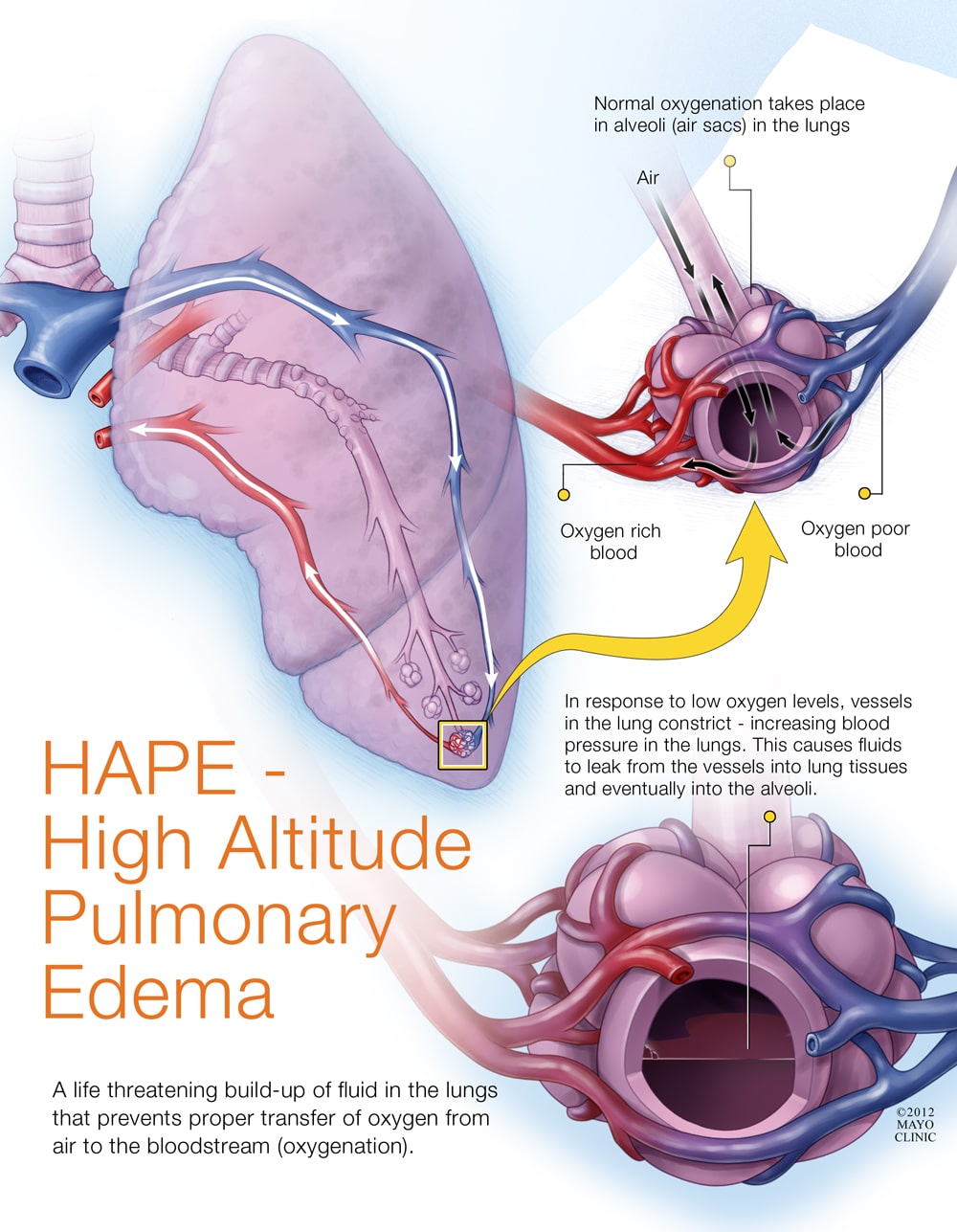 The science of how high altitudes allow HAPE to cause fluid accumulation in the lungs.