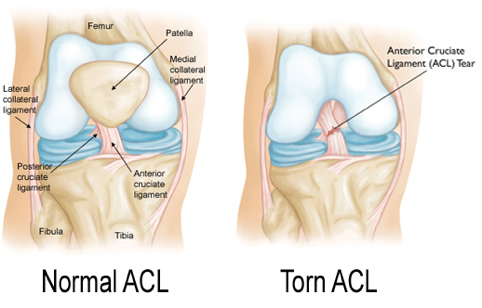 Don't Let An Injury Cut Your Season Short! - SnowBrains