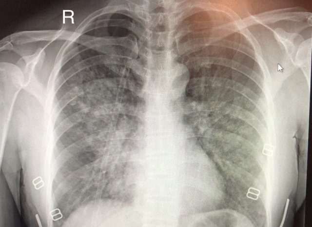 Image of a chest X-ray of a victim of HAPE.