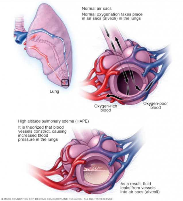 High Altitude Pulmonary Edema Diagram