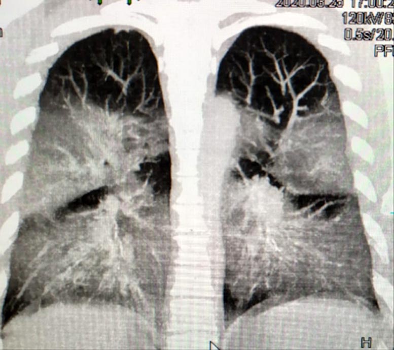 Shows how COVID-19 attacks the lungs