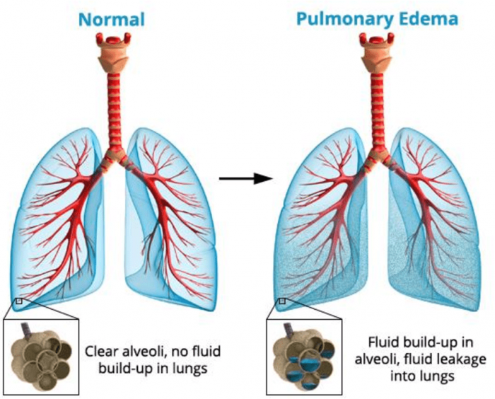 effects-of-high-altitude-on-the-lungs-snowbrains