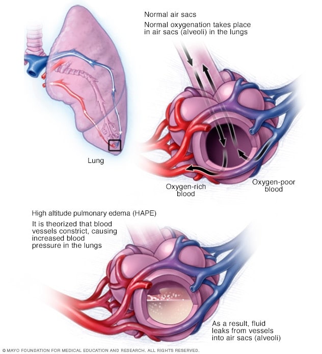 This is an illustrated visual that shows how HAPE affects air sacs within the lungs.