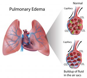 Drawing of lungs shows pulmonary edema 