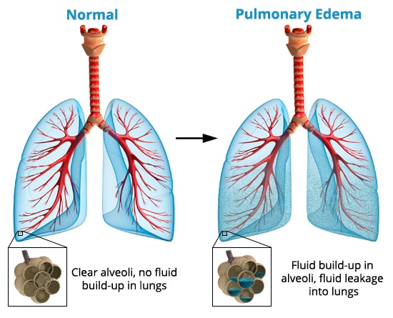 Normal lungs vs HAPE lungs