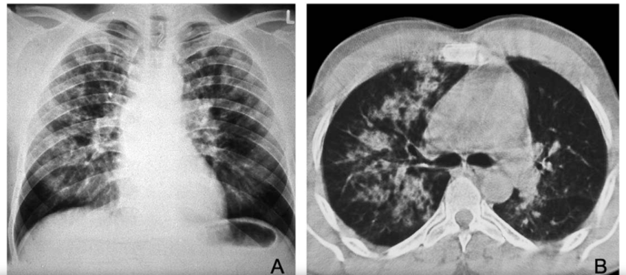 HAPE X-Ray and CT Scan