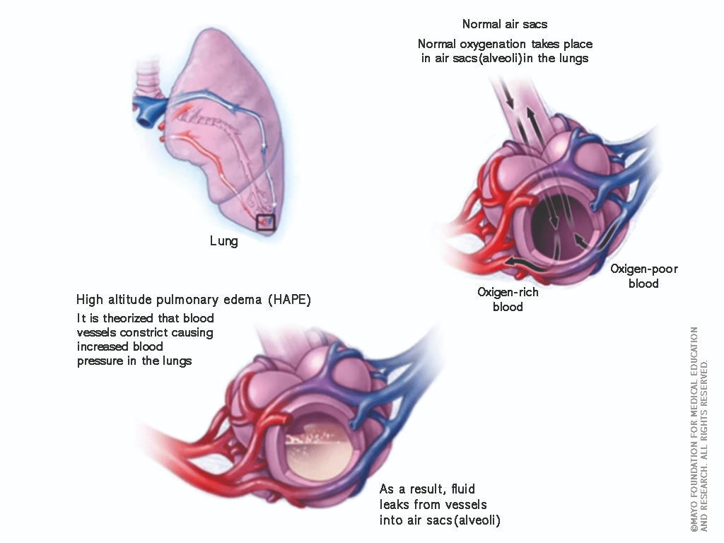 Medical drawing showing physical effects of HAPE