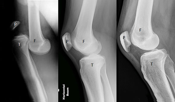 MRI MCL tear treatment knee surgeon adelaide recovery time