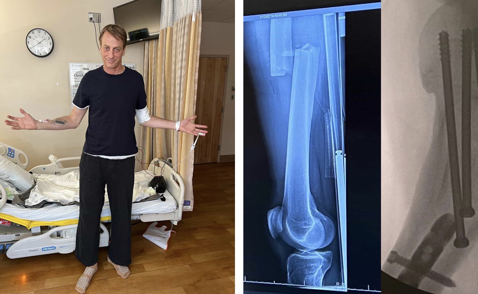 Tony Hawk breaks his leg but isn't retiring