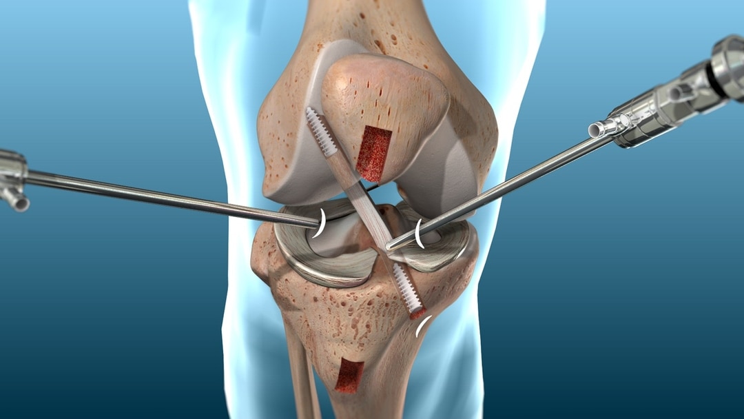 acl knee surgery