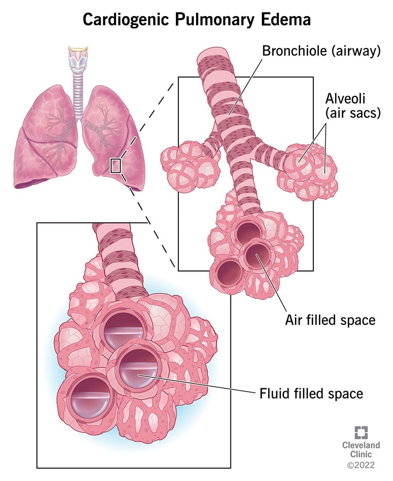 Pulmonary Edema