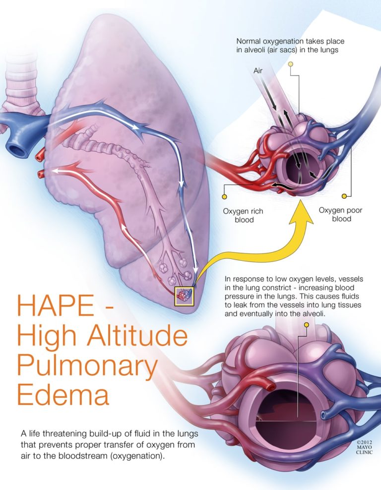 pulmonary edema diagram