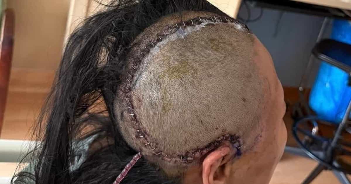 Photo of the huge scar following the emergency brain surgery | Photo: Lynn Ban Instagram